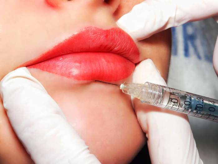 Impact on Lip Filler